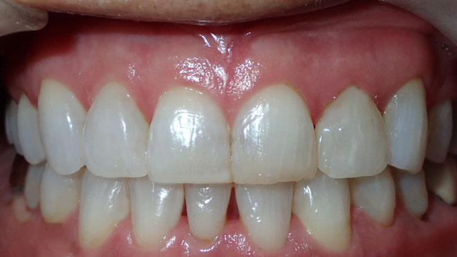 Invisalign Clear Braces Granada Hills, Northridge, Porter Ranch