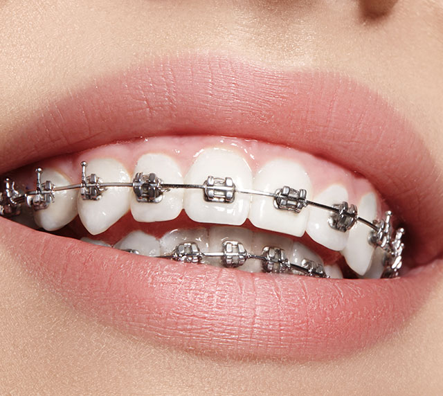 Orthodontic Treatments